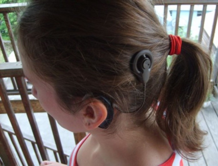 implante-coclear-otorrinolaringologa-otologia-bogota-implantes-cocleares-audifonos-baha-hipoacusia-audicion-presbiacusia-bebes-audiometria-infantil-cirugia-oido-protesis-auditivas